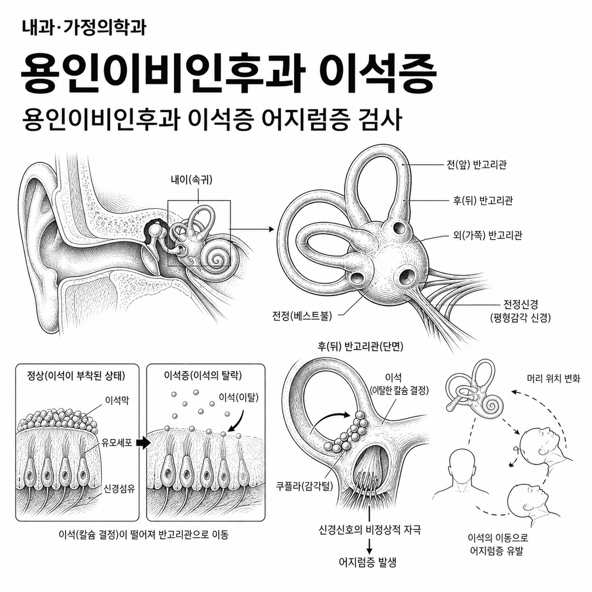 경기 내과 용인이비인후과 이석증 핵심 정보 이미지